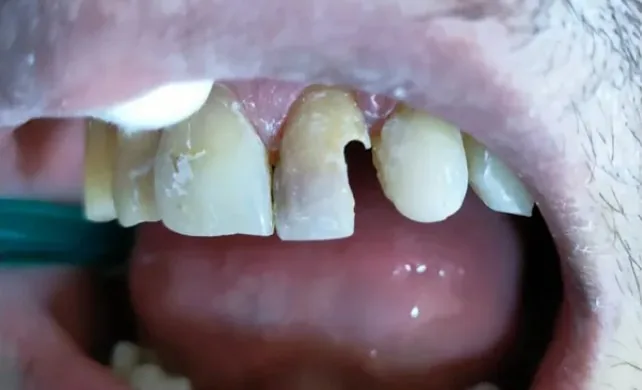 Resultado antes - Restauración dental